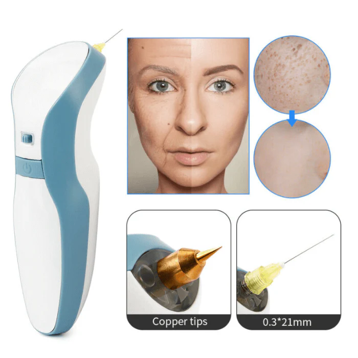 Professional Fibroblast Plasma Pen Skin Tag Removal - Image 4