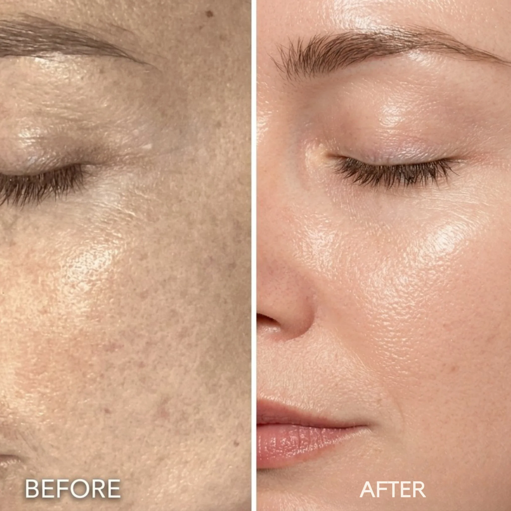 Micro Infusion Microneedle Kit for Face - Image 2